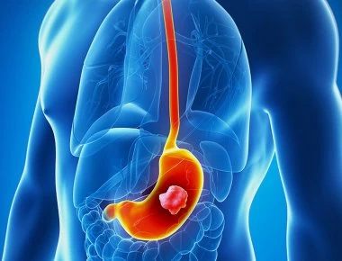 Καρκίνος του στομάχου: Τα απλά συμπτώματα που πρέπει να προσέχετε